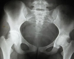 Knee Joint Replacement