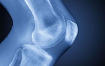 Total Knee Replacement Surgery in Delhi